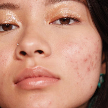 Skin Purging vs. a Breakout